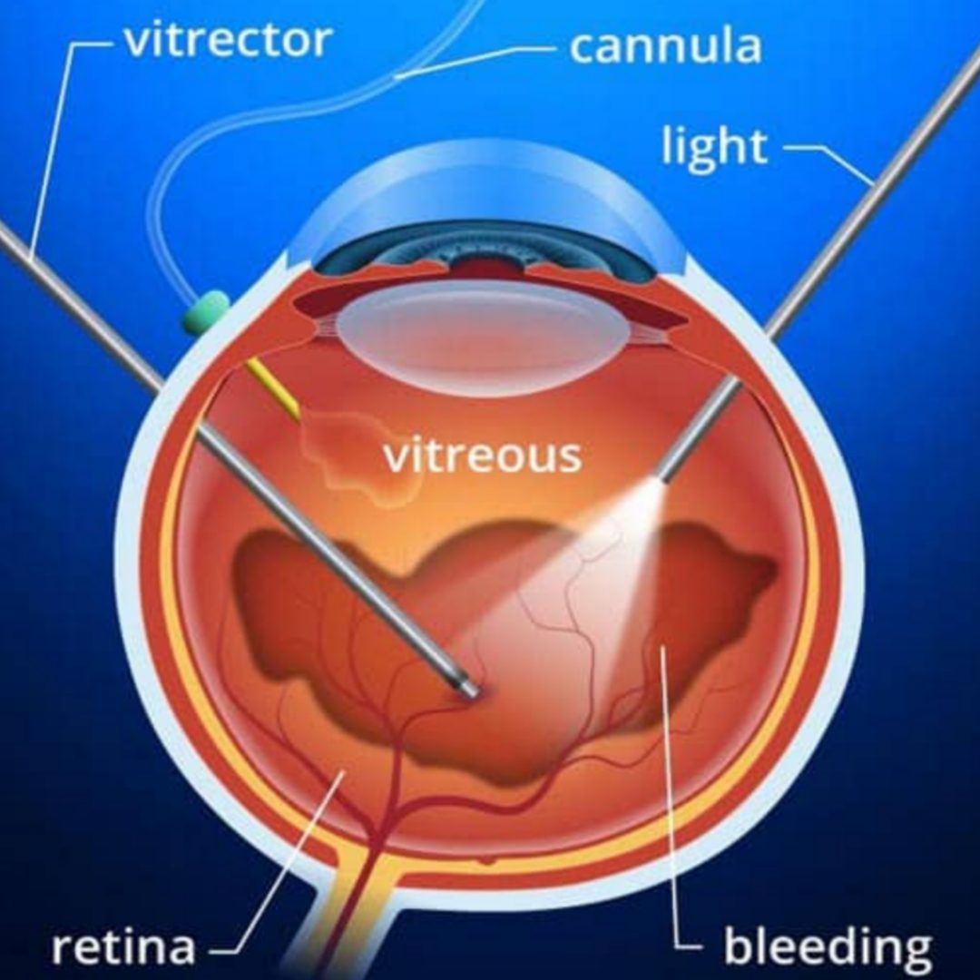 best eye hospital in Jalandhar
