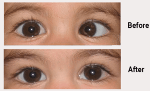 Squint Eye Treatment in Jalandhar