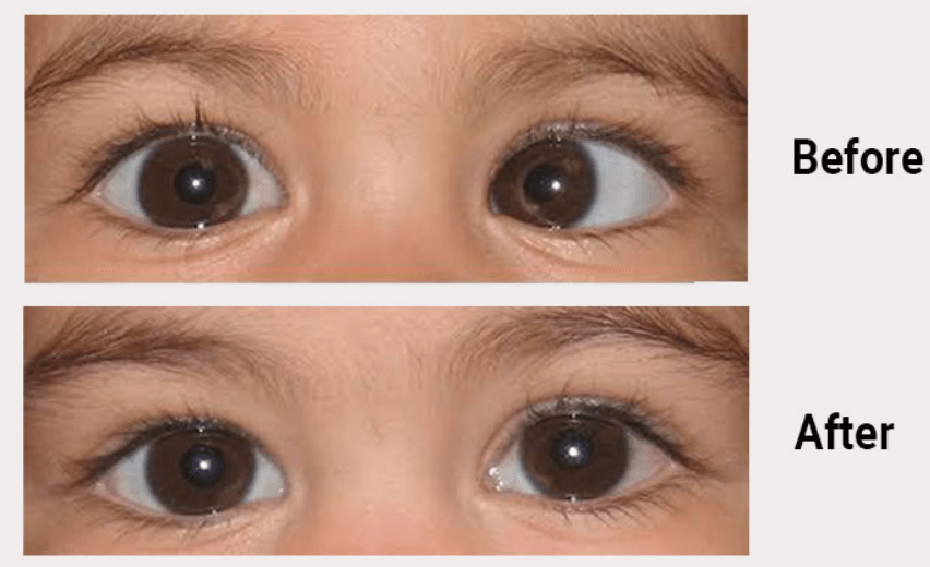 Squint Eye Treatment in Jalandhar