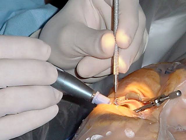 Cost of Cataract Surgery in Jalandhar